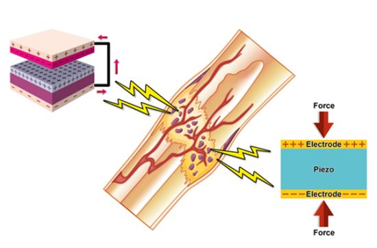 Using Bone’s Natural Electricity to Promote Regeneration